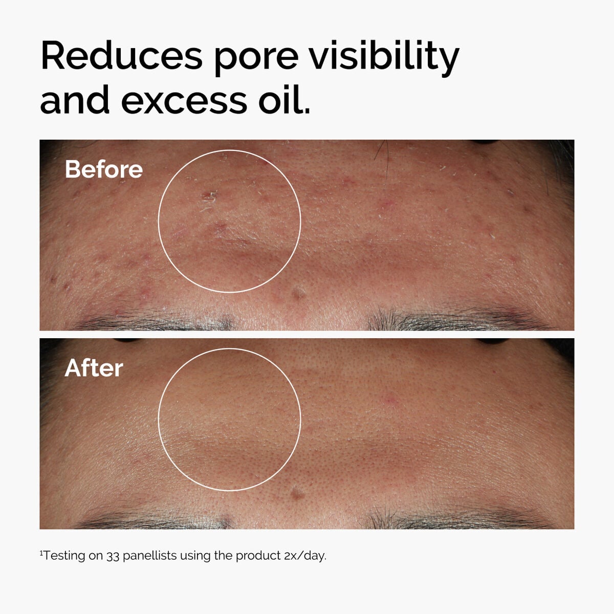 niacinamide-10-zinc-1-r9 ord-niacinamide-zinc-blemish-serum-before-after-pores.jpg