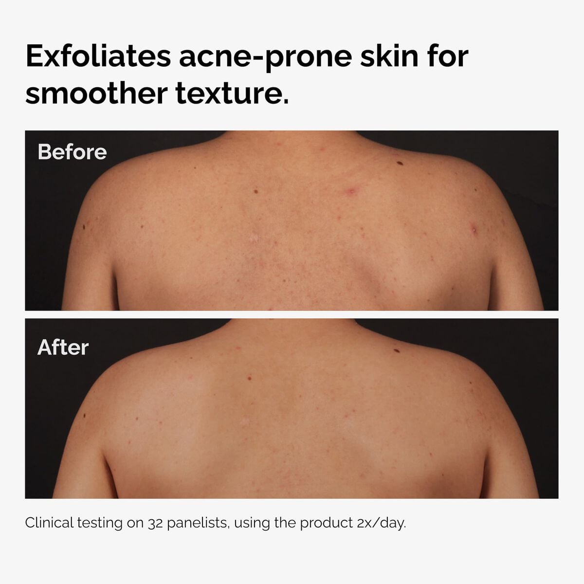 salicylic-acid-0-5-body-serum-z6 ord-salicylic-acid-body-serum-before-after-graphic-NA.jpg