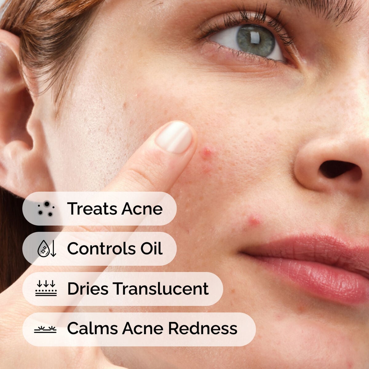 sulfur-10-powder-to-cream-concentrate-r7 ord-sulfur-10pct-powder-to-cream-concentrate-model-application-with-benefits-acne.jpg
